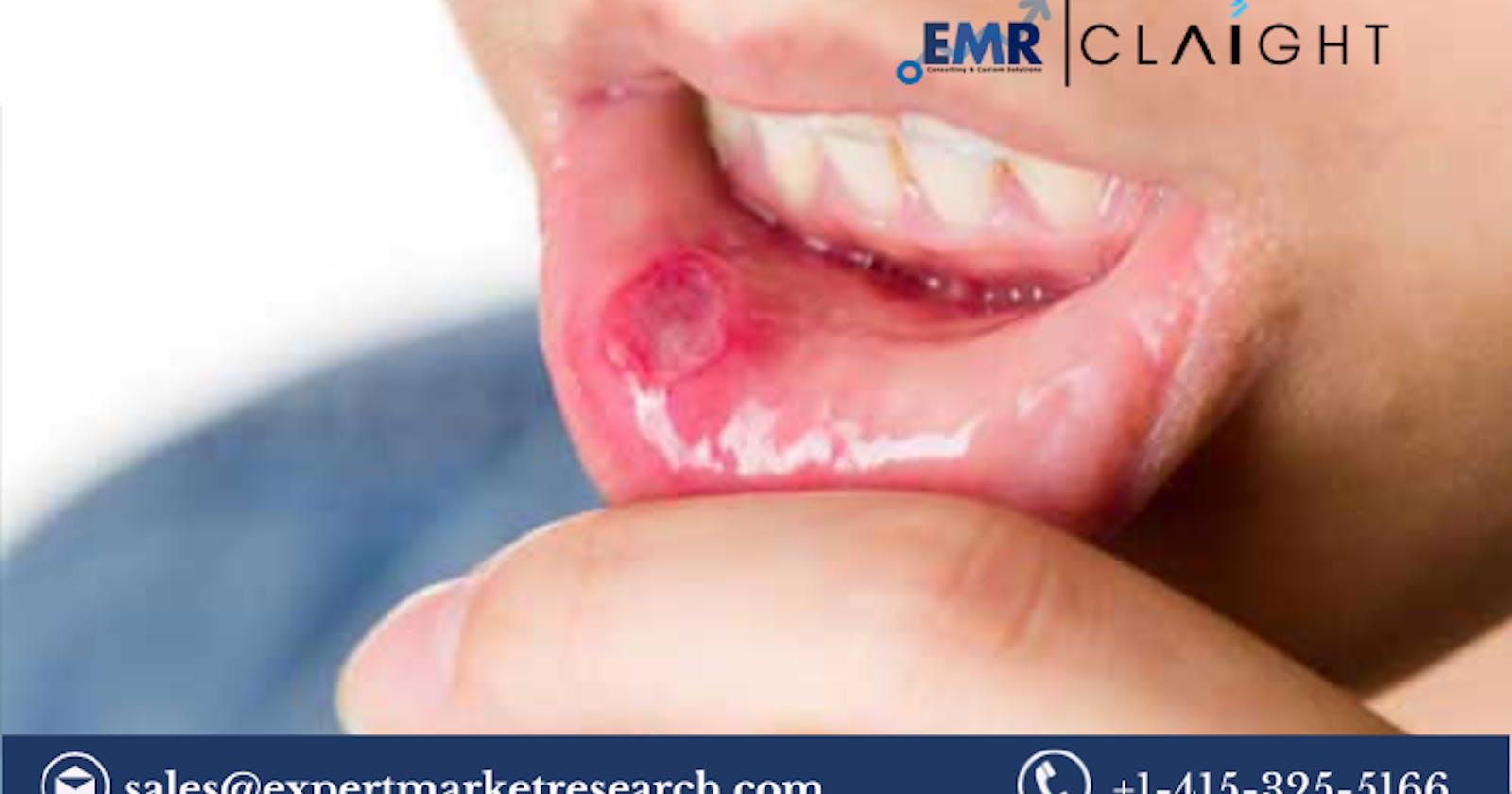 Mouth Ulcer Treatment Market Size, Share, Trends 2024-2032