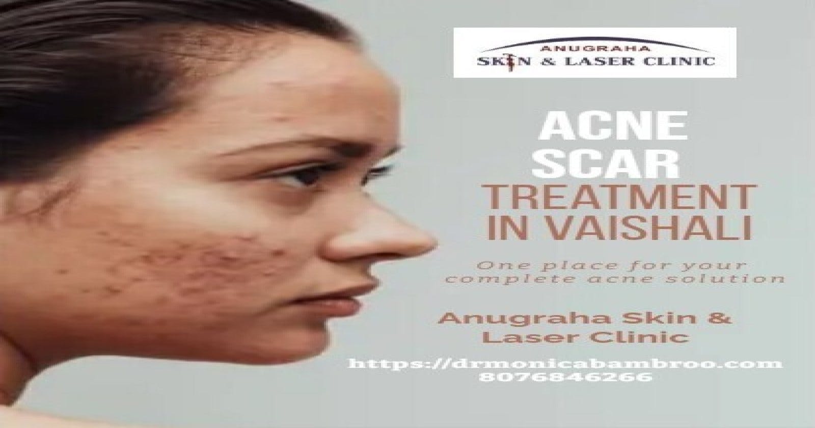 Revitalize Your Skin: Acne Scars Treatment in Vaishali and Stretch Mark Treatment in Indirapuram with  Dr. Monica Bambroo