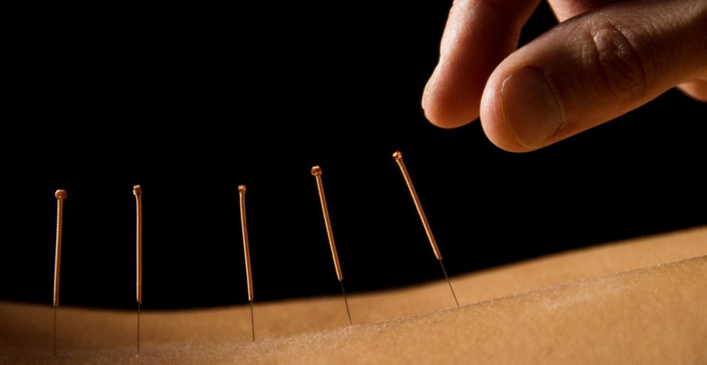 Discover the Healing Power: Acupuncture in DC