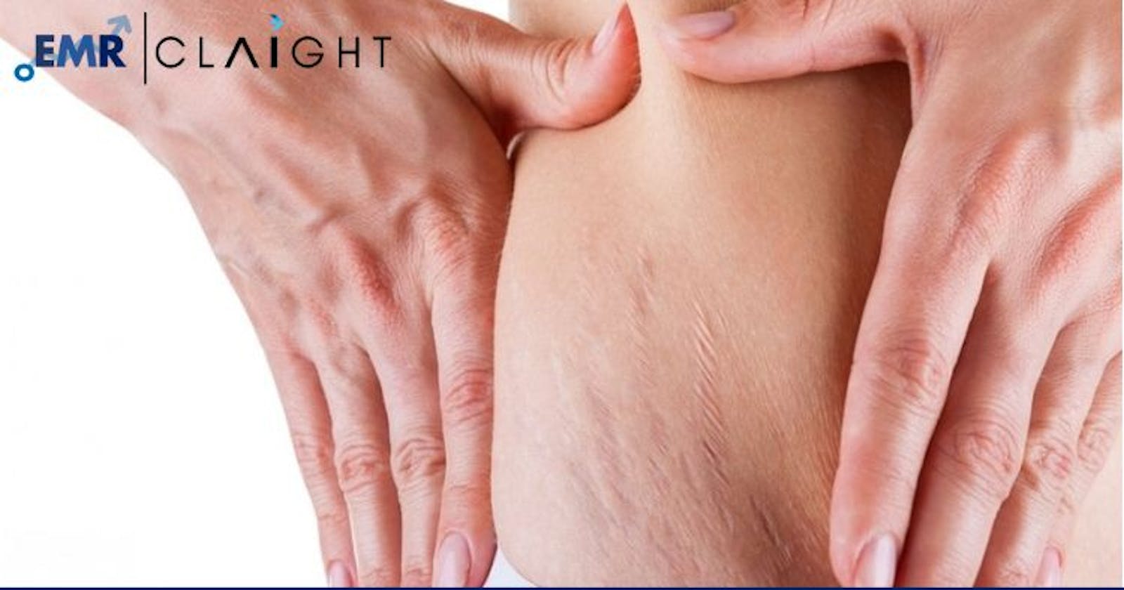 Stretch Marks Treatment Market Size, Share, Trends 2024-2032