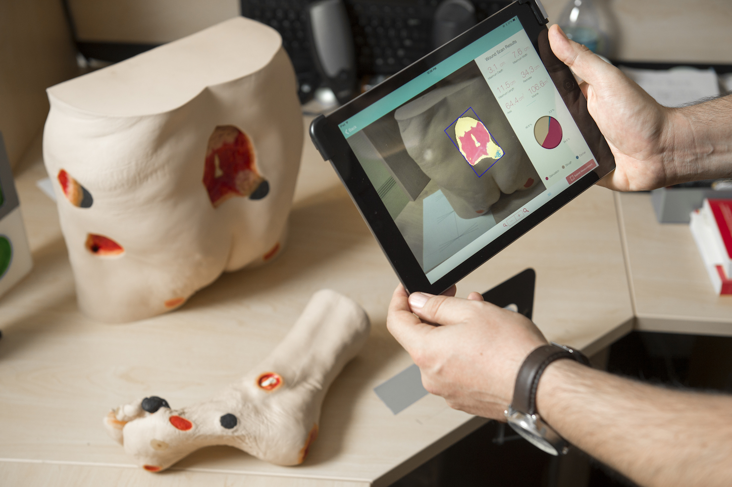 Revolutionizing Wound Care: Innovations Driving Digital Wound Measurement Devices
