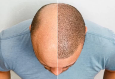 Revolutionary Hair Restoration Treatments You Must Explore