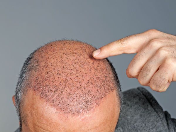 Step-by-Step Process of FUE Hair Transplant Surgery