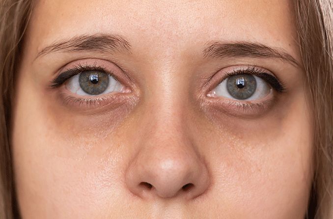 Comprehensive Guide to Effective Treatments for Dark Circles Under Eyes