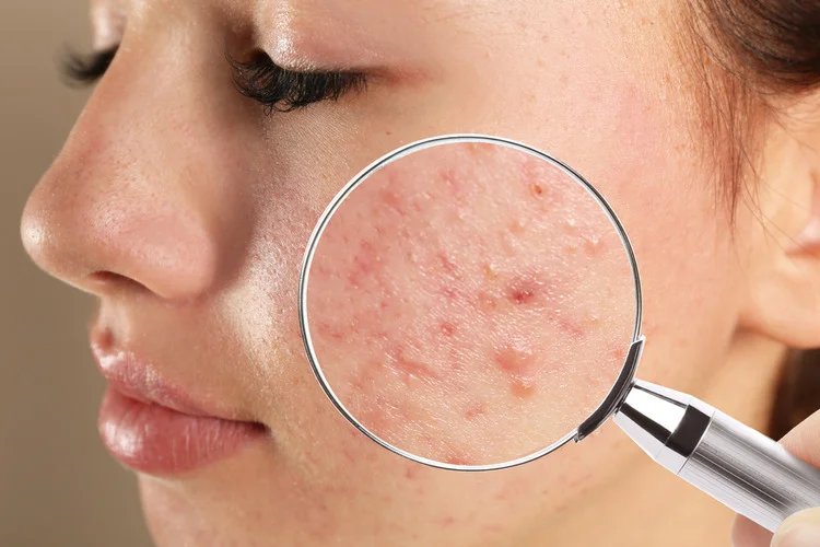 The Ultimate Guide to Effective Acne Treatment
