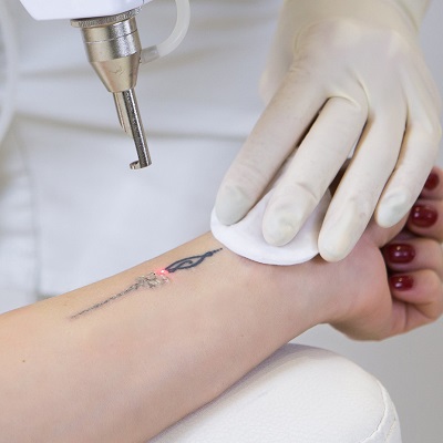 Affordable Laser Tattoo Removal in Dubai: Clear Your Skin