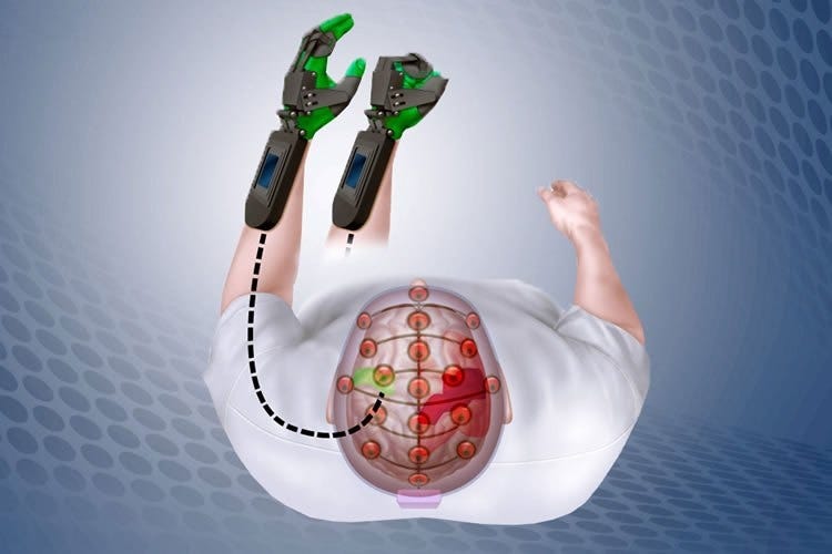 Global Neuroprosthetics: Restoring Function and Empowering Lives