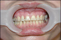 Reasons to Consider Dental Implants Over Other Alternatives