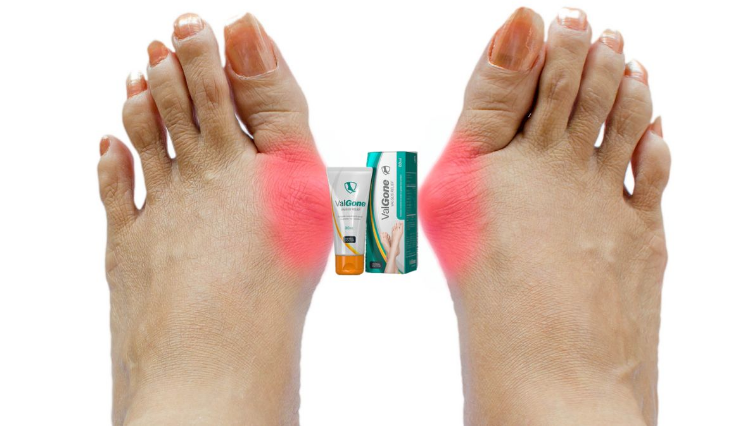 ValGone Price - Get Improvement In Infections And Valgus!
