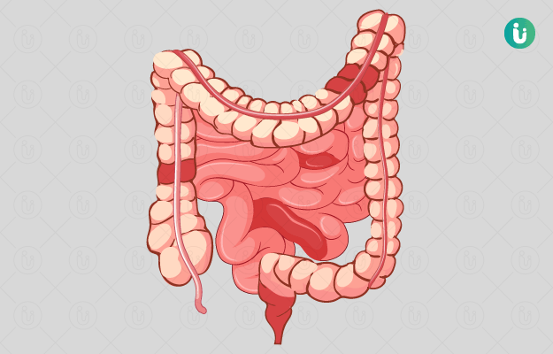 The Physical Effects of Crohn’s Disease