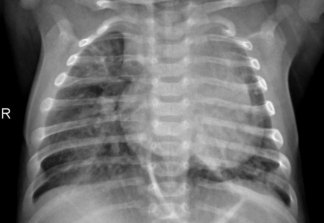 How to Create a Pneumonia Detection Model with Convolutional Neural Networks