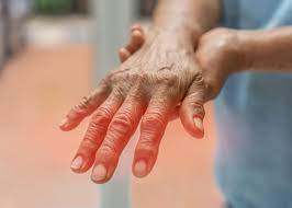 Understanding Peripheral Neuropathy: What It Is, Its Symptoms, and Treatment Options