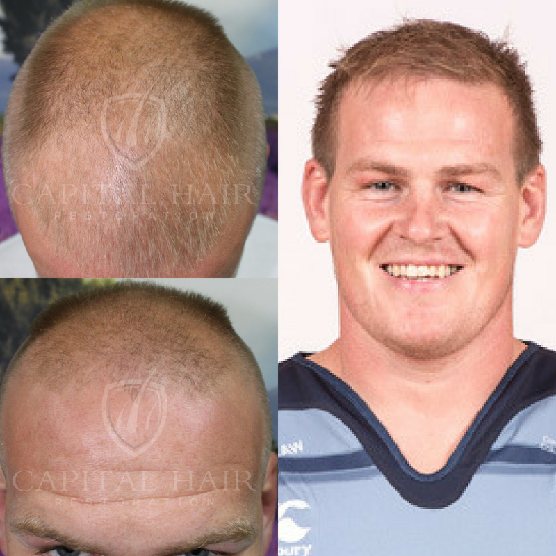 The Transformative Journey of Hair Transplant: A Before and After Perspective