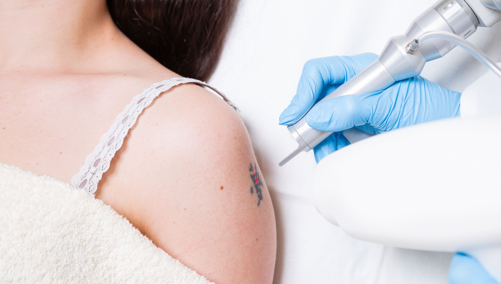 The Journey from Tattoo to Clear Skin with Laser Tech