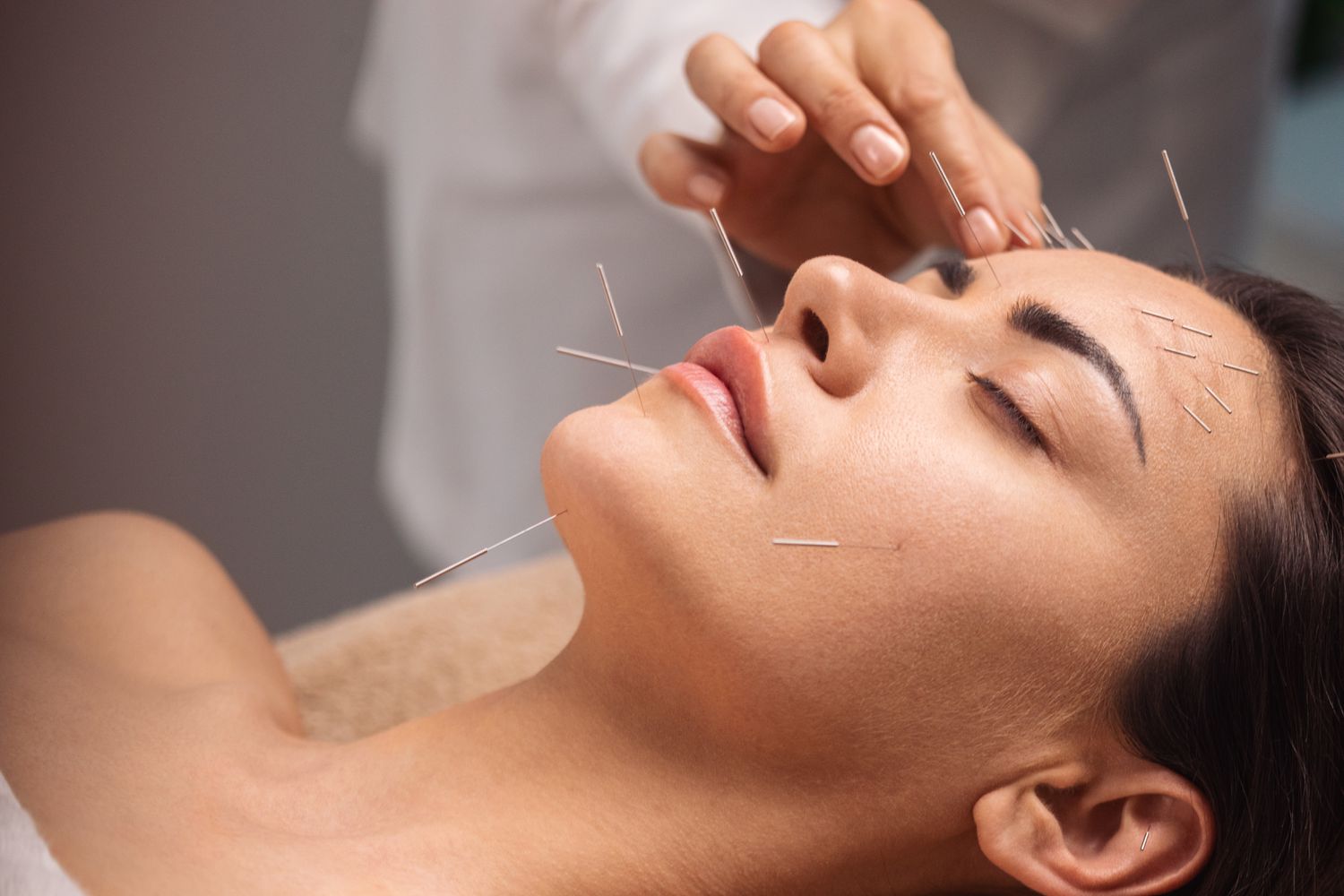 How Facial Acupuncture In San Diego Enhances Your Natural Beauty