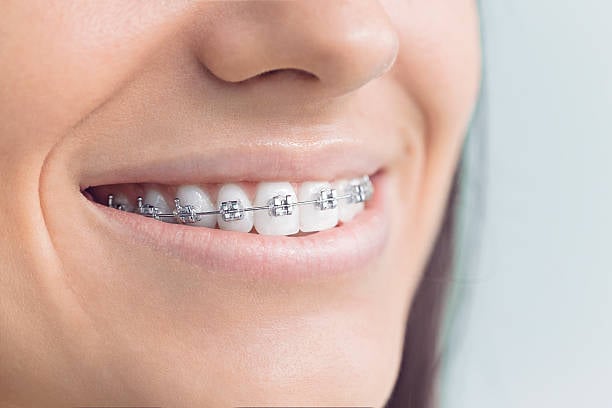 The benefits of Braces for Your Teeth and Your Smile