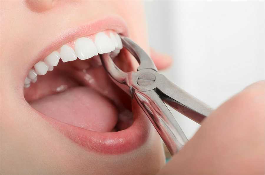How Much Does Tooth Extraction Cost in Dubai? Tips for Finding Affordable Options