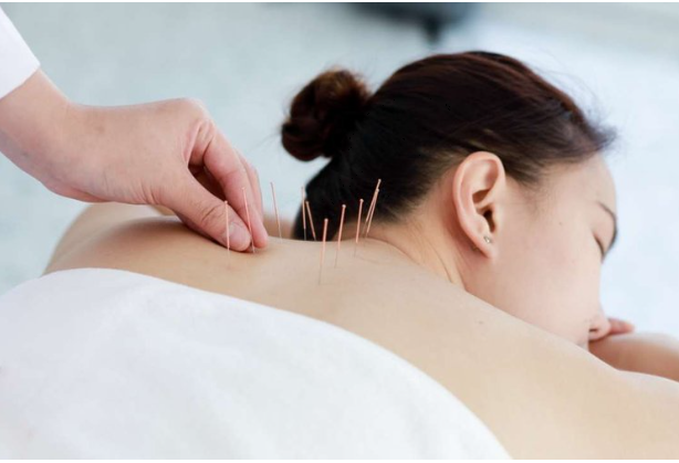 Acupuncture Adelaide