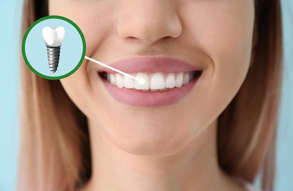 Dental Implants: A Comprehensive Guide