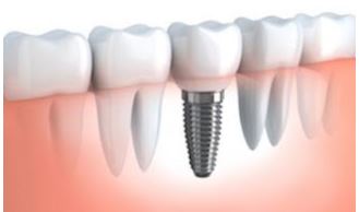 Dental Implants Melville