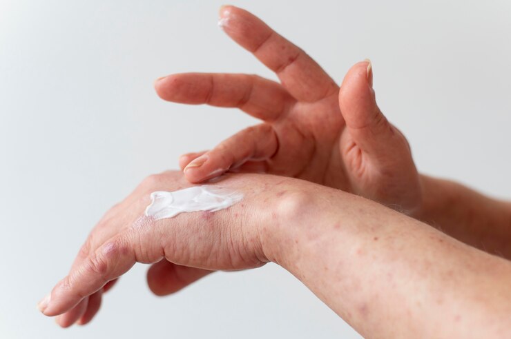 Eczema Skincare: Balancing Moisture and Protection