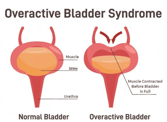 Normal and OAB comparison