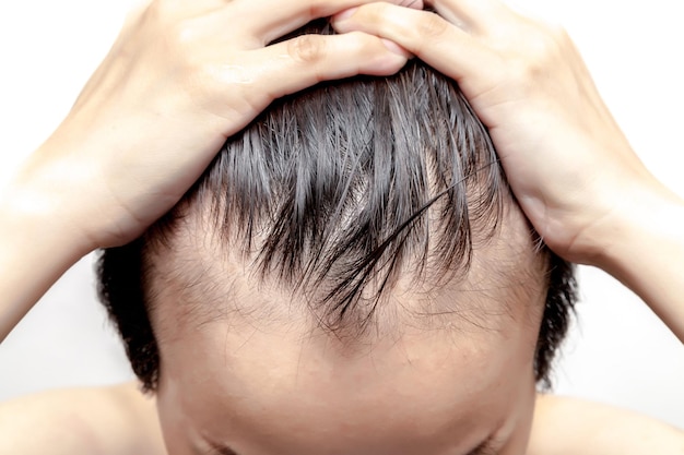 Can Hair Replacement Restore Your Natural Hairline?