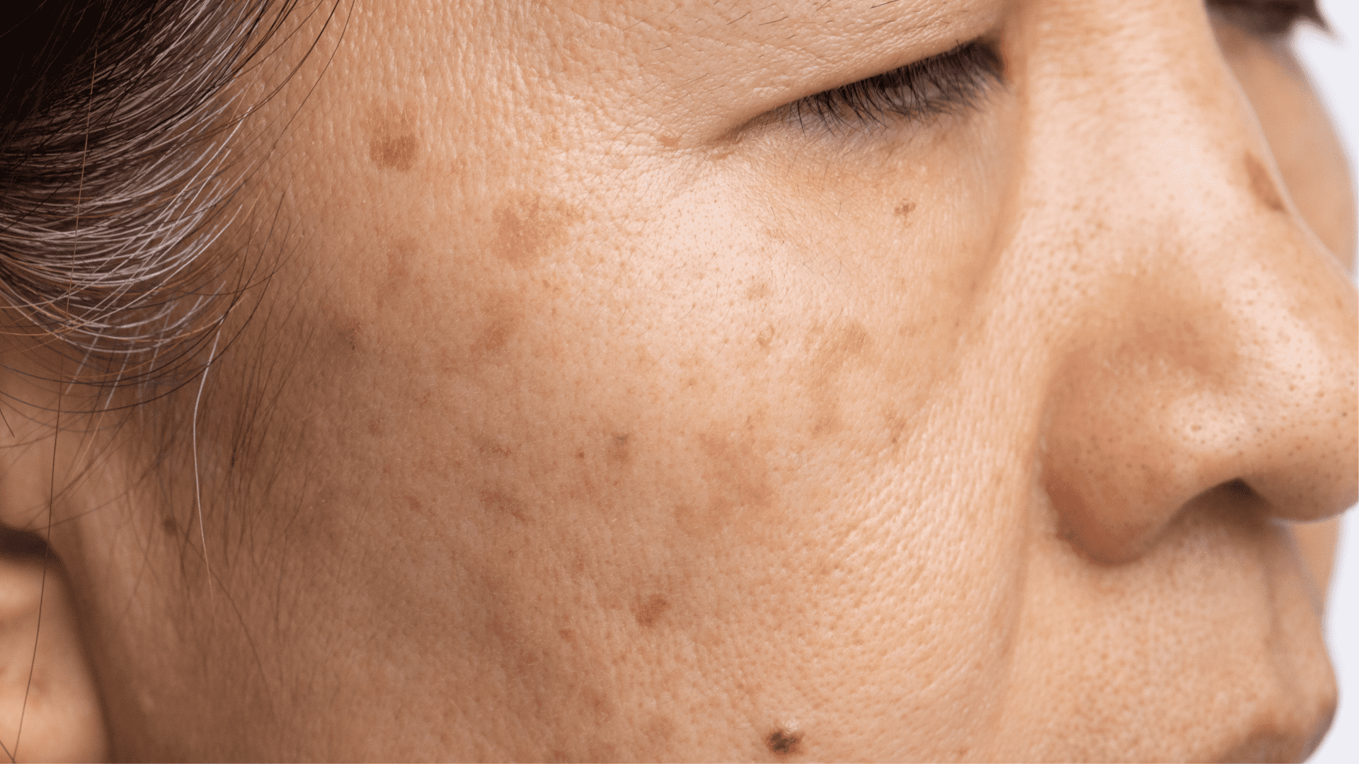 What to Expect During Dermal Pigmentation Treatment?