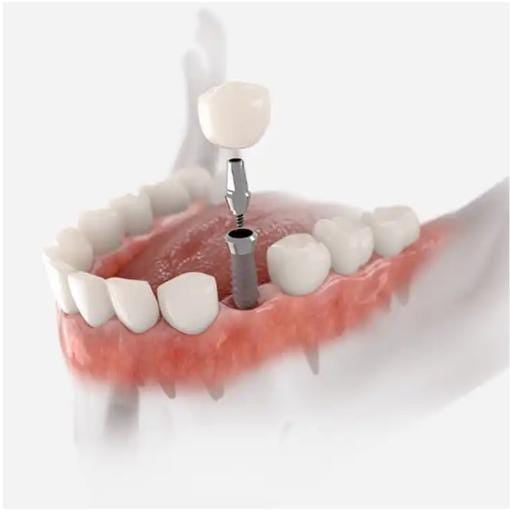Crowns in Turkey: A Guide to Affordable and High-Quality Dental Solutions