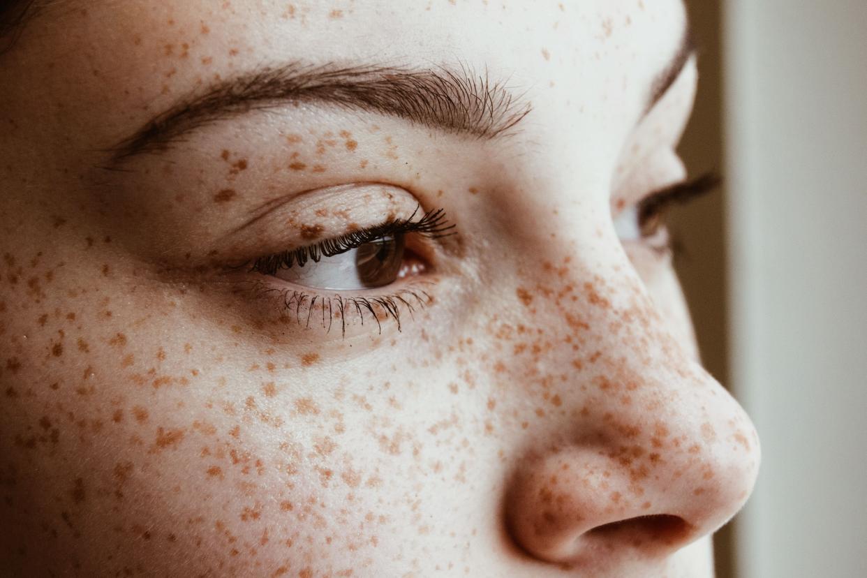 How Can You Spot the Best Milia Treatments Nearby?