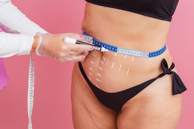 Is liposuction 100% safe for abdominal fat?