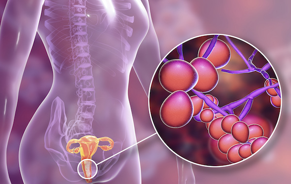 What Are the Best Ways to Prevent Vaginal Infections?