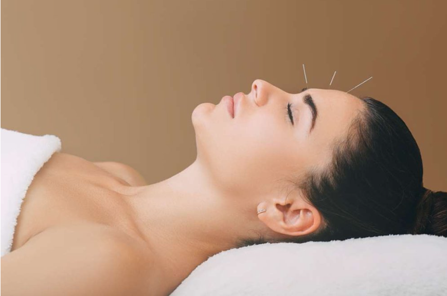 Acupuncture Adelaide