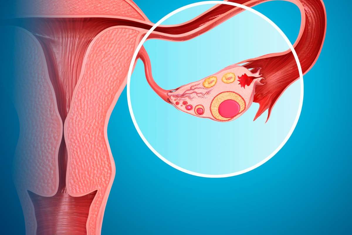 Can You Still Get Pregnant with Ovarian Cysts? A Doctor Explains!