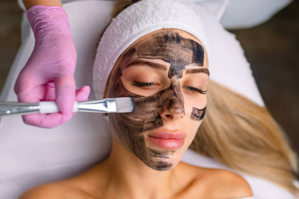 What Are the Benefits of Laser Carbon Peels?