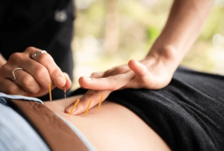 How Often Should You Get Dry Needling? A Guide for Patients