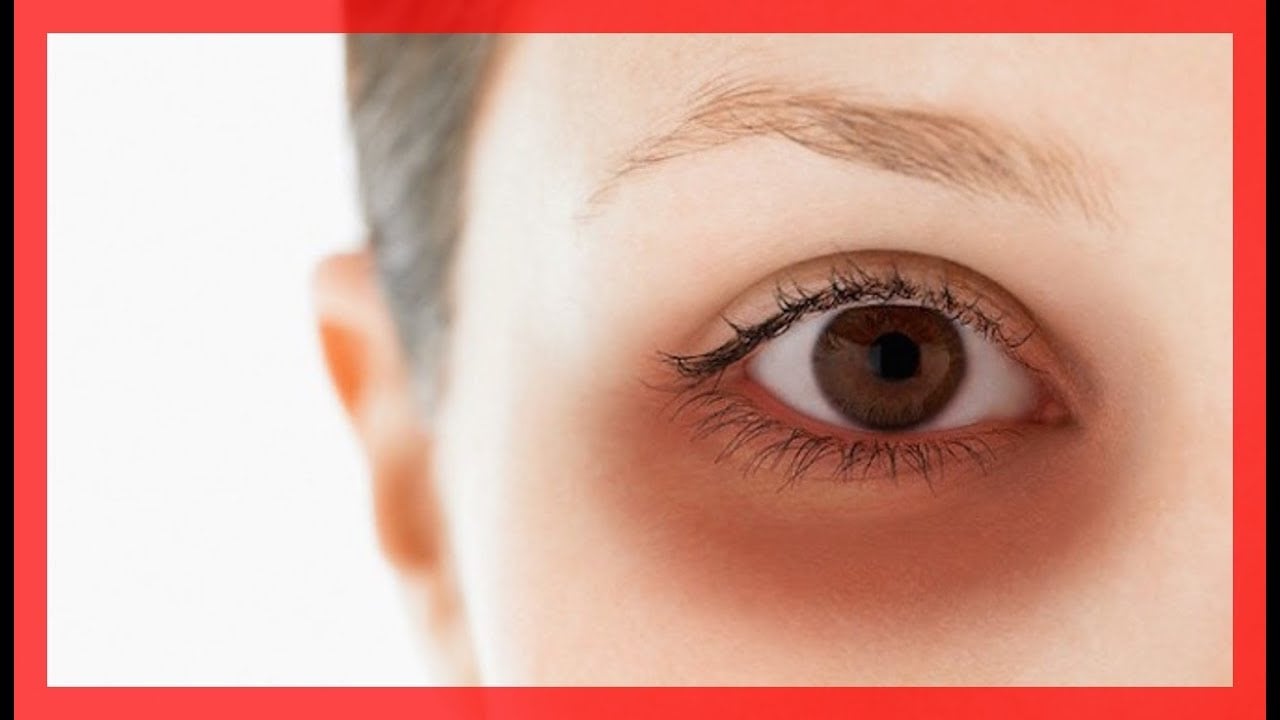 Emerging Technologies in Dry Eye Syndrome Treatment to Drive Exponential Market Growth