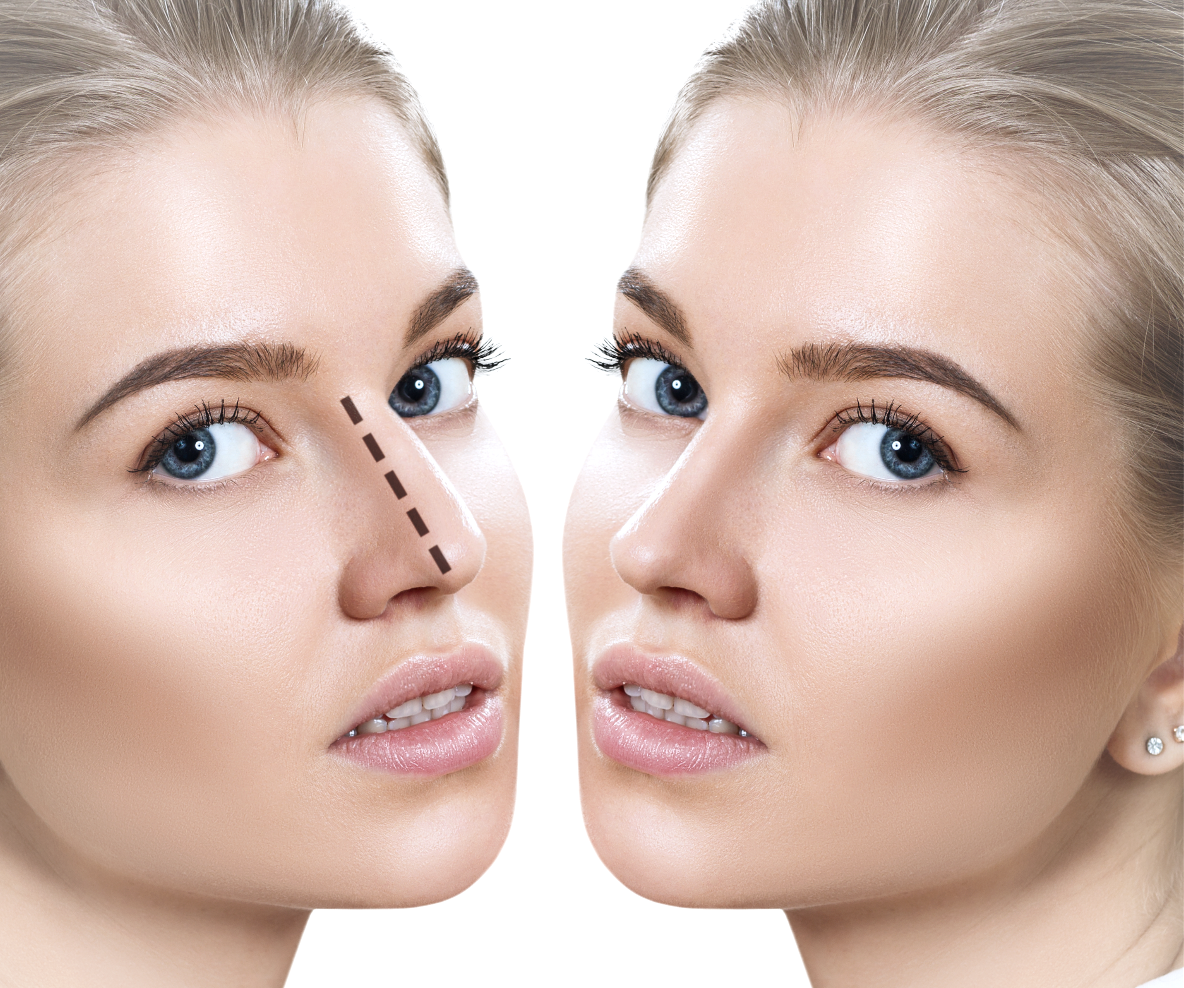 Your Dream Nose Awaits: Rhinoplasty Insights