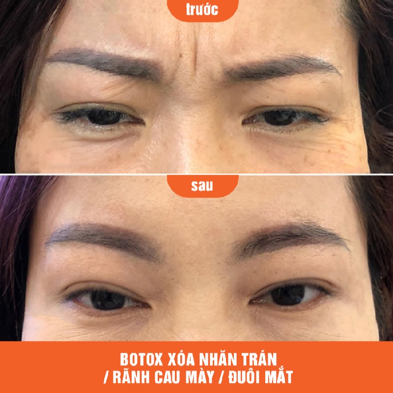 Nếp Nhăn Trán - "bộ Lọc" Đo Lường Sức Khỏe & Vận Mệnh