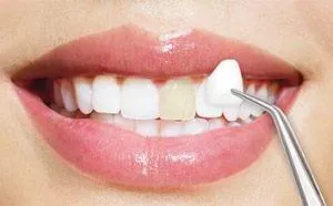 What Are Dental Veneers and Their Top Advantages?