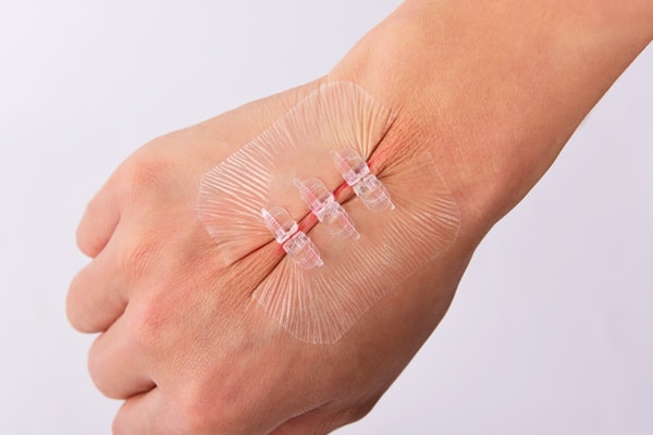 Wound Closure Market is Estimated to Witness High Growth Owing to Rising Incidences of Traumatic Injuries