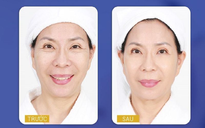 Da Mặt Bị Nhăn Khi Cười: Nguyên Nhân & Cách Khắc Phục Hiệu Quả