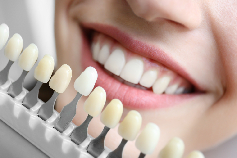 How You Can Achieve a Hollywood Smile in Miami