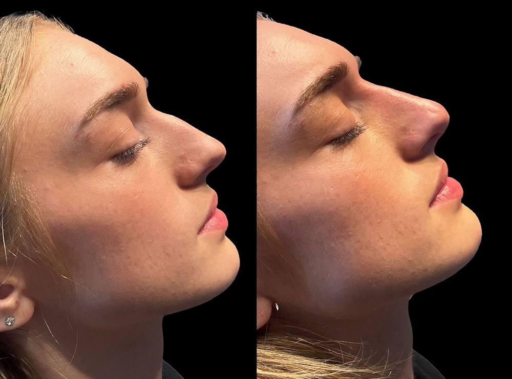 From Classic to Contemporary: Rhinoplasty for Every Style