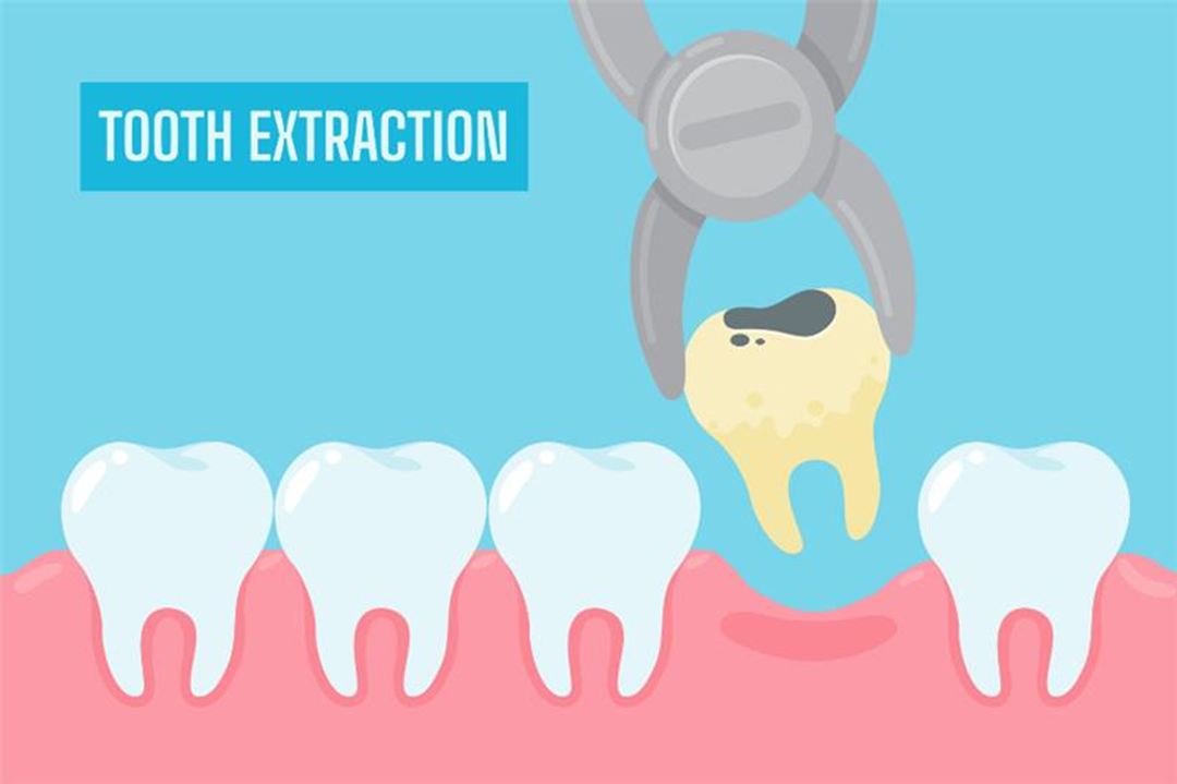 Tooth Extraction in Canberra – Comfortable & Hassle-Free Wisdom Teeth Removal