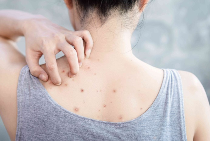 How to Get Rid of Bacne Fast with Expert Treatment in Singapore