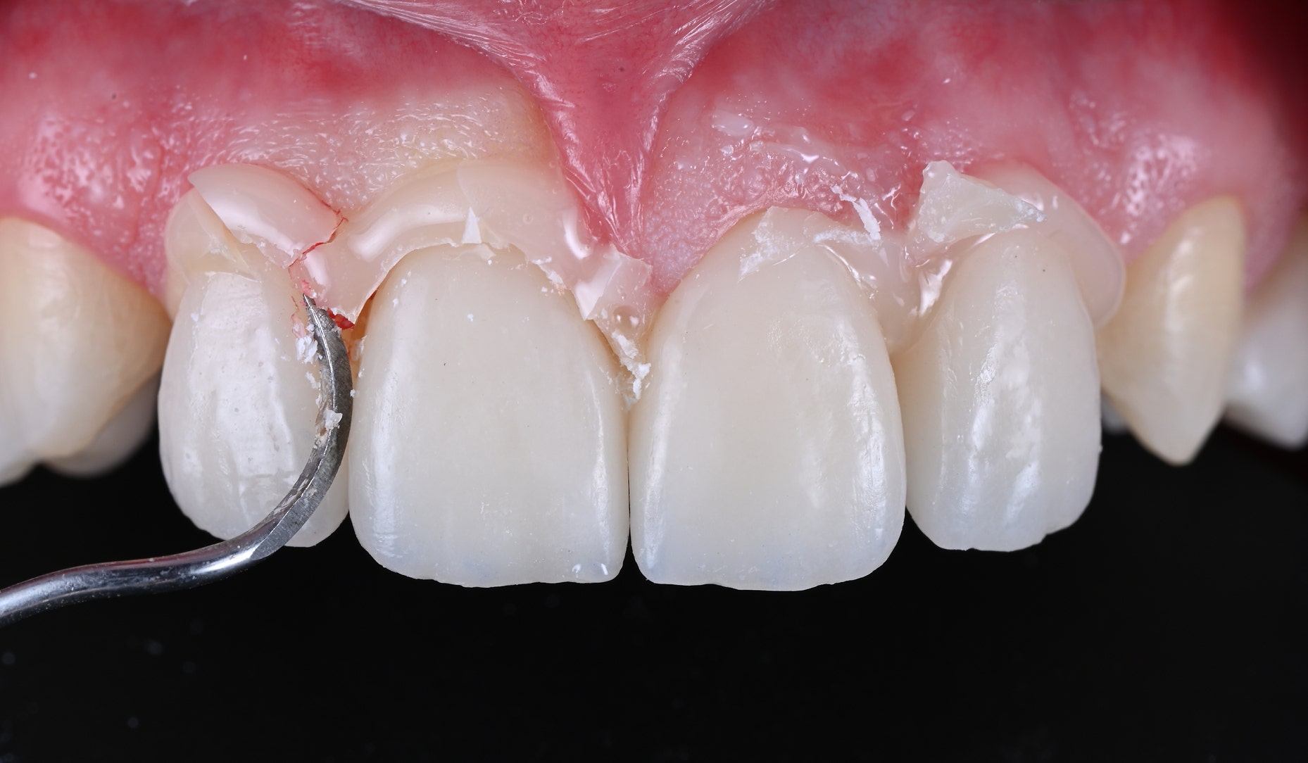 How Long Does Dental Bonding Last?