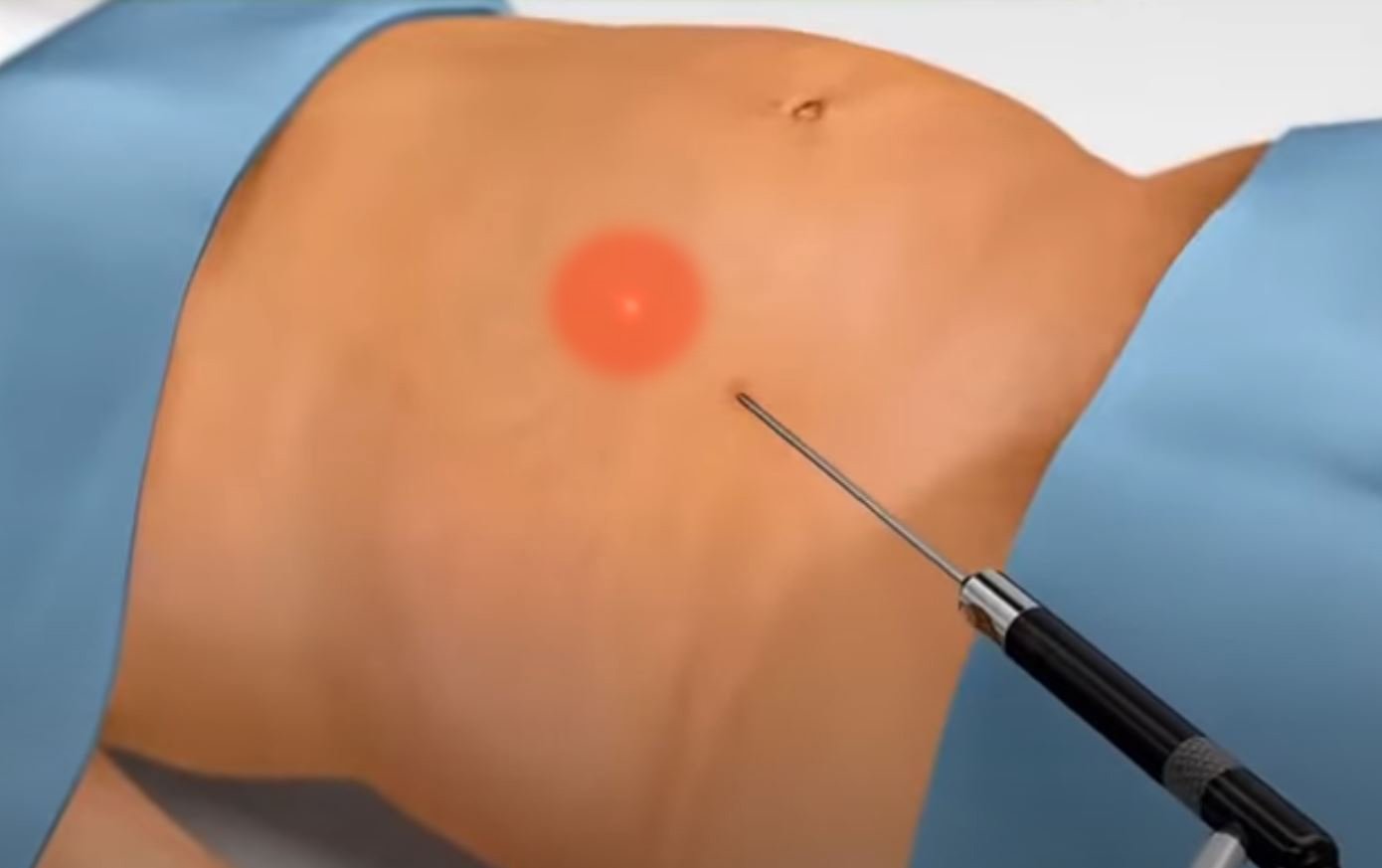 Laser Liposuction in Dubai