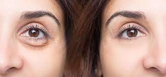 Lower Eyelid Support: Critical Surgical Techniques to Prevent Post-Blepharoplasty Complications