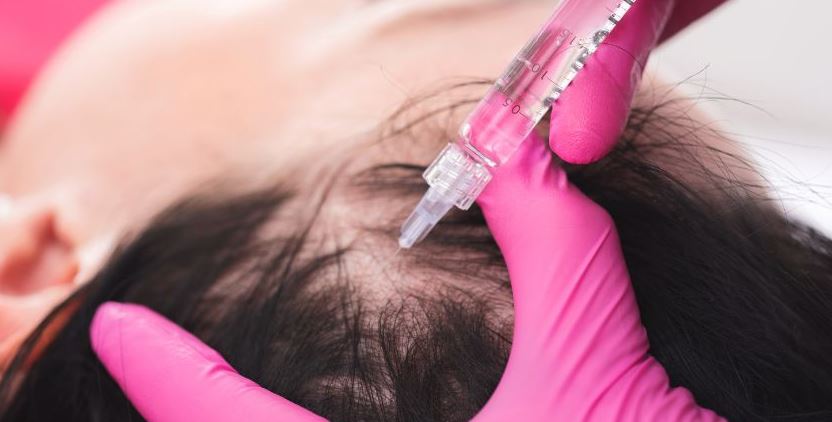 Hair PRP in Your 30s: Prevention or Overkill?